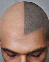 Micro Pigmentation for scalp.