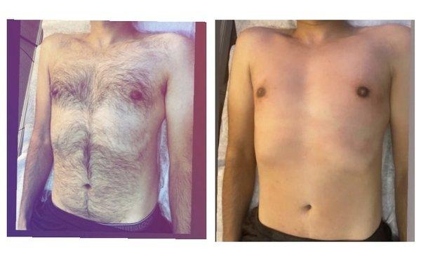 Before after chest and stomach wax