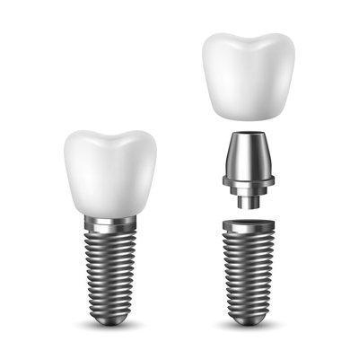 Single Tooth Dental Implants