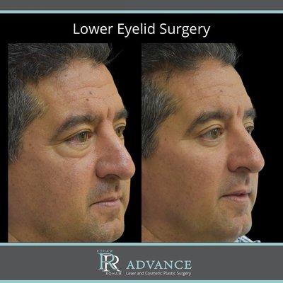 Lower Eyelid Surgery