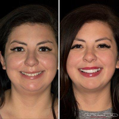 Stunning smile transformation with porcelain veneers! She almost looks like a different person on the right side!