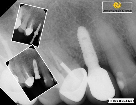 Dental implant- a conservative way to replace missing teeth where we don't have to grind on the adjacent teeth!