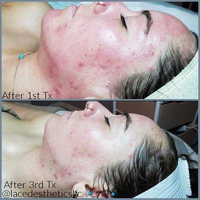 I can help you repair your damaged acid mantle allowing you to become less sensitive to products and treatments