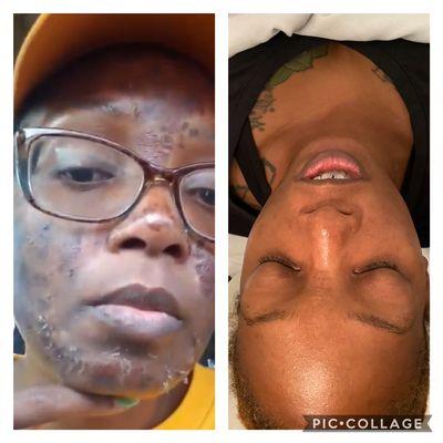 Chemical peel before and after photo