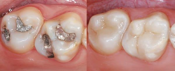 Before and after photos, existing amalgam replaced with composite.