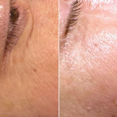 One Lactic Berry Peel with Microcurrent & Ultrasound