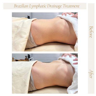 Lymphatic Drainage