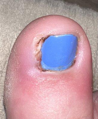 Infected toe from a pedicure, a week later