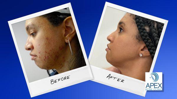 Acne patient with clear skin after treatment at Apex Dermatology.