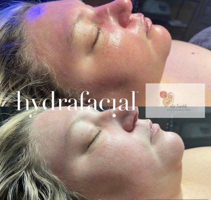 Hydrafacial Before and After