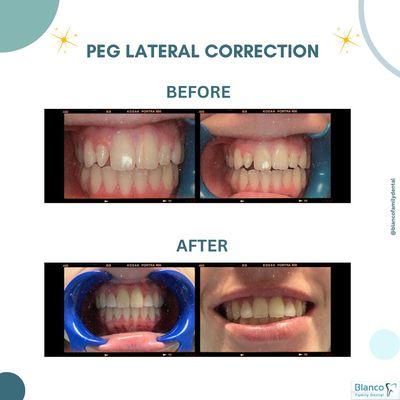 Check out the amazing results of one of our recent Peg Lateral Corrections!!