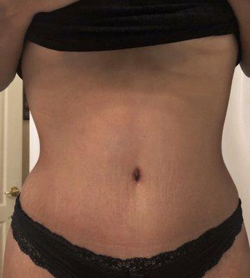 These are my results 3 months after my tummy tuck! I am happy and grateful.