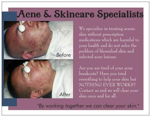 Acne Treatment Before and After