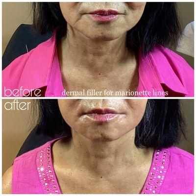 dermal filler marionette lines