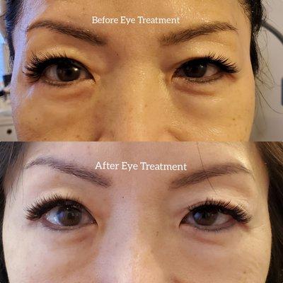 Lifting Eye treatment