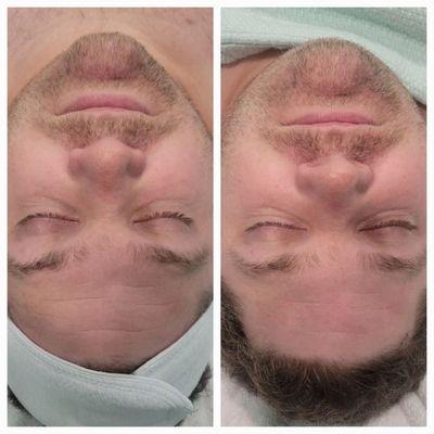 Geneo Glo2Facial before & after