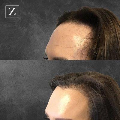 Female Hair Restoration