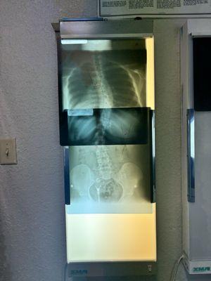 My X-Ray Scans of my Scoliosis