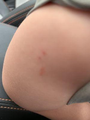 3 puncture marks for one vaccine...