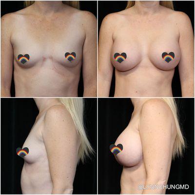 Transaxillary breast augmentation with saline implants