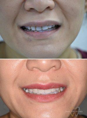 Cosmetic veneers for a healthy new natural smile!