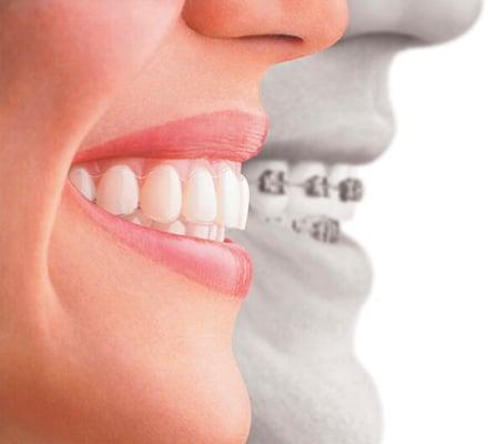 Invisalign and traditional braces available!