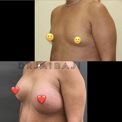 Breast augmentation with silicone implants