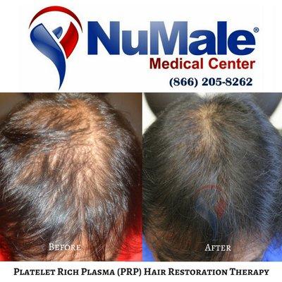 Platelet Rich Plasma (PRP) Hair Restoration Therapy for Men. NuMale Medical Center