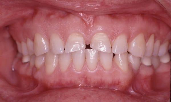 Patient needing ceramic crowns