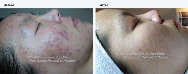 Face Reality Acne Clearing Program.