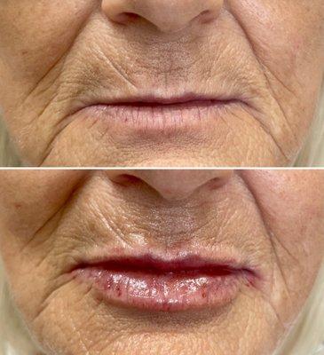 Fuller, hydrated, and more youthful lips using hyaluronic acid fillers