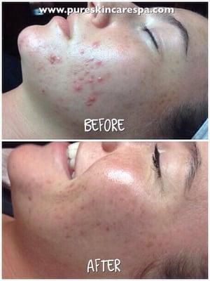 Another Acne Bootcamp Success!! She achieved clear skin in 3 months without harsh medications or prescriptions!