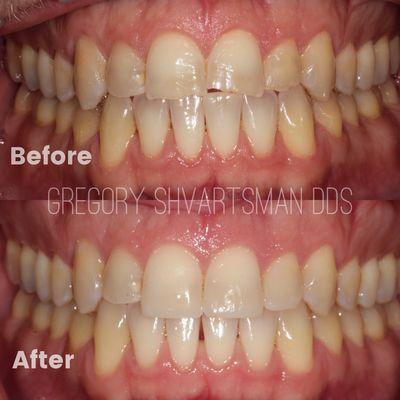 Before and after Invisalign treatment and bonding to straighten teeth and repair chipped edges.