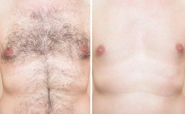 We offer chest waxing for both men and women