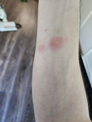 The first bites I noticed on my arm