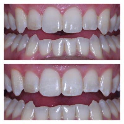 Conservative Cosmetic Composites allow us to repair broken teeth in a single visit.