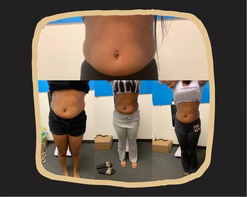 Non surgical tummy tuck