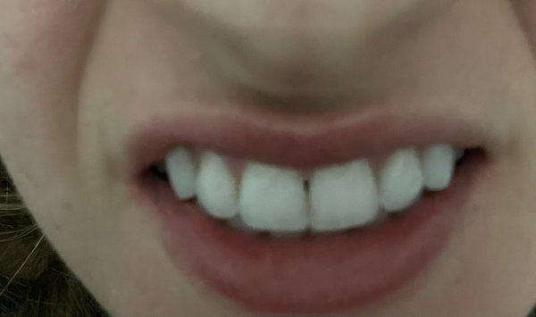 My teeth AFTER treatment. Way worse.