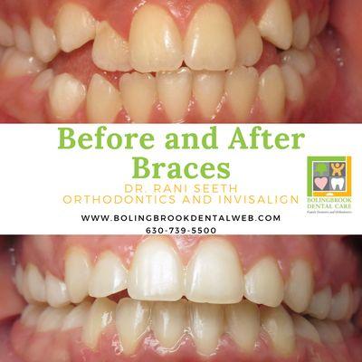 #bolingbrookdentalcare #orthodontics #dentist