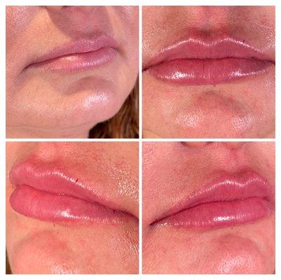 Lip Filler Before + After