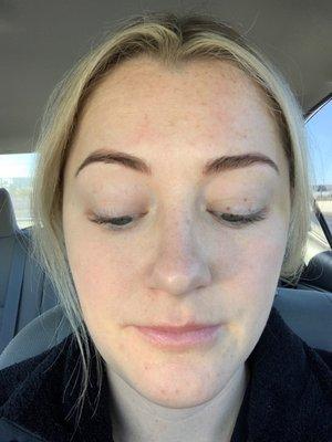 Treated crows feet, elevens, and forehead. Instant results!