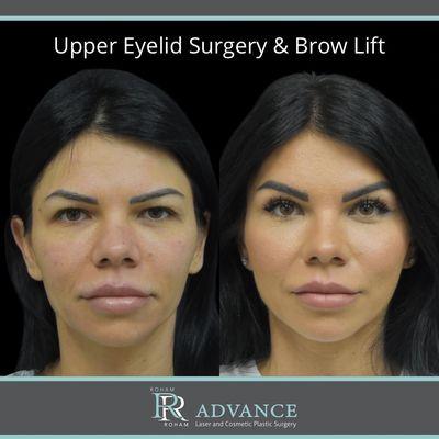 Upper Eyelid Surgery & Brow Lift