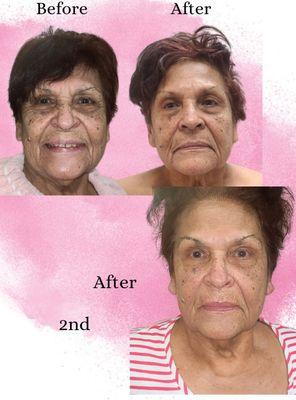 Anti-aging facelift treatment