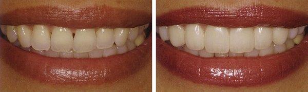 Custom smile makeover using Lumineers.