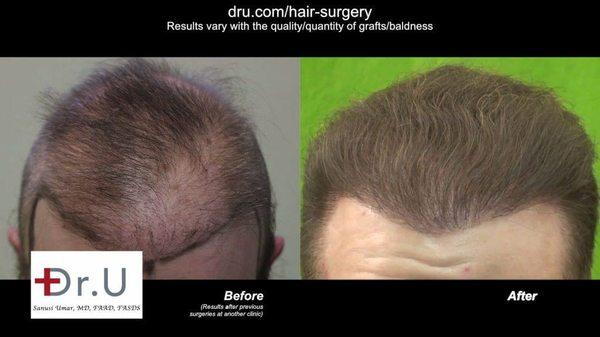 Norwood Level 6 Baldness Hair Transplant Results - Dr. Sanusi Umar, MD - Dr. U Skin & Hair Clinic Before & After Results V1