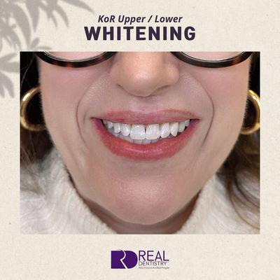 Whitening