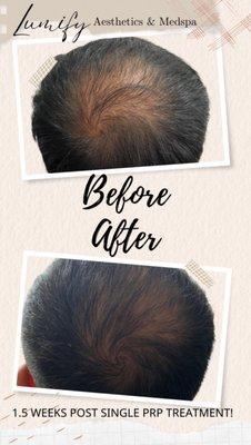 PRP hair restoration. After one session.