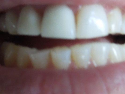 My ground down teeth that were straight before Dr.P tried to make a crown fit....