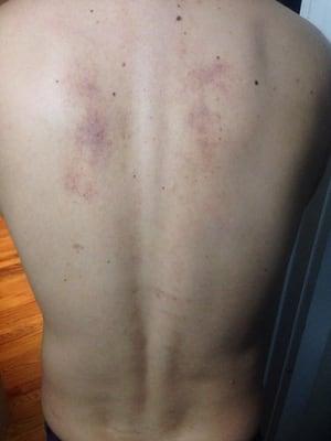 The bruises the woman left on my husbands back after what was supposed to be a relaxing massage.