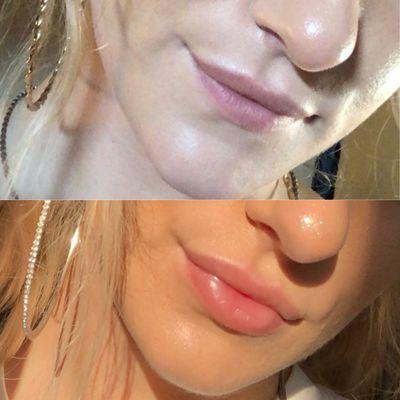 Juvederm for lip plumping and volumization